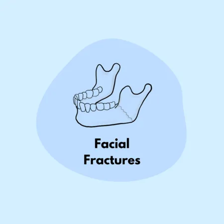 Facial Fractures