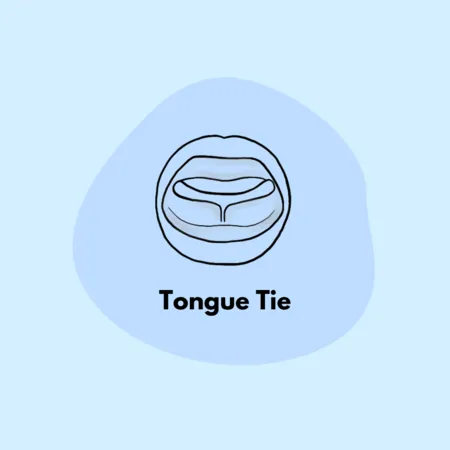 Tongue Tie